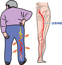 盛岡で坐骨神経痛の治療なら 盛岡市口コミ1位の亀太郎はり灸整骨院 整体